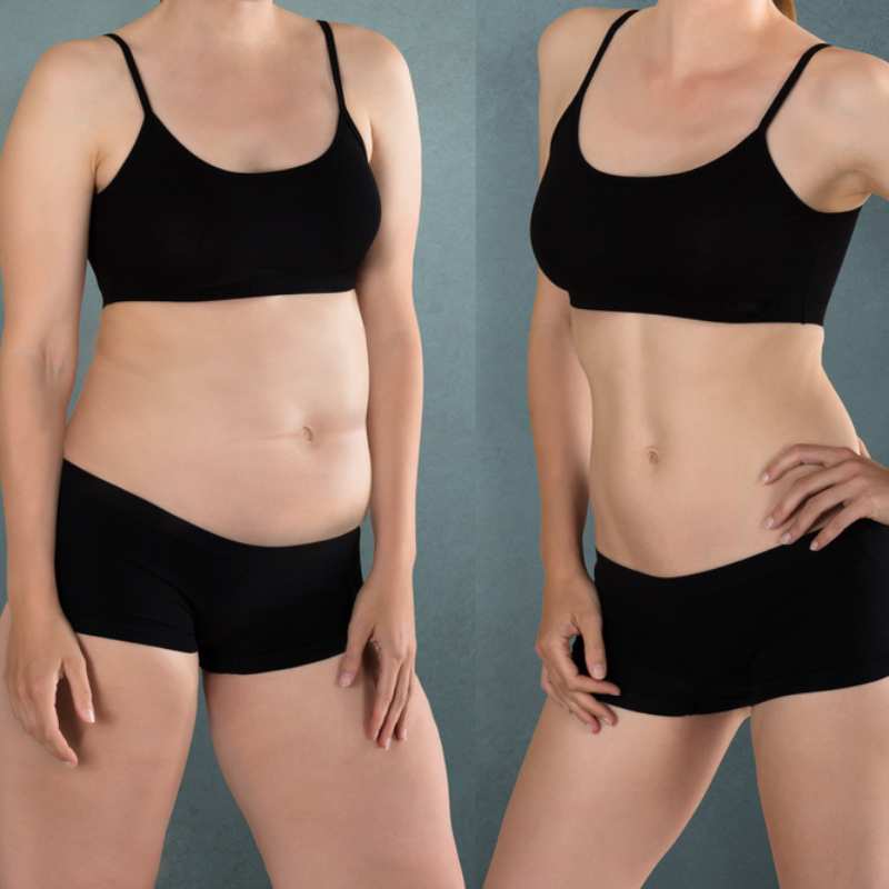 Does Fat Freezing at Home Work? DIY Devices vs Professional Cryolipolysis 2 before and after Cryolipolysis Lyndhurst