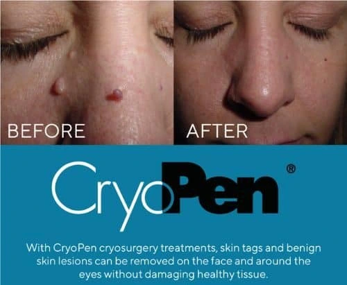 image of angiofibroma removal Lyndhurst using Lipo Sculpt cryopen!